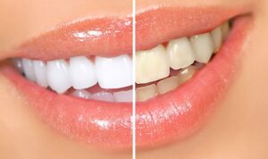 Blanqueamiento Dental en Tenerife