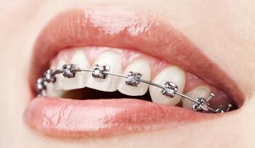 Dentista brackets de baja fricción