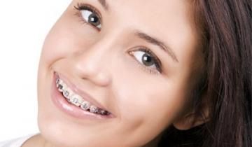 Dentista brackets metálicos