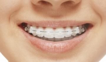 Dentista brackets estéticos