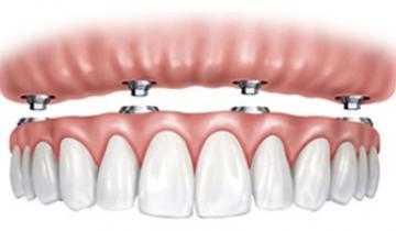 Dentista prótesis dental