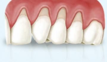 Dentista tratamiento estético de encía