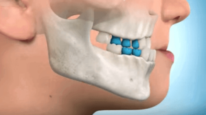Ortopedia funcional estimulacion avance maxilar