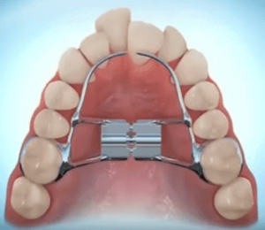 Ortopedia funcional expansion maxilar superior