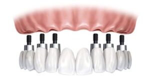 Protesis dental santa cruz
