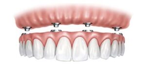 Protesis dental la laguna