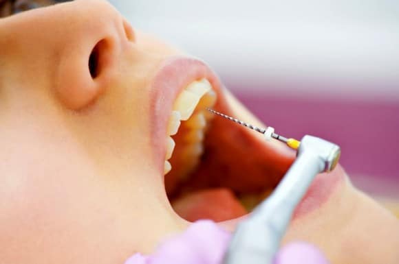 Sesiones de endodoncia en Tenerife
